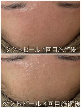 リエル(Liel)/ダクトピールで赤み軽減★