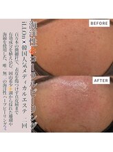 クラルテアンドコー(Salon Clarte&Co.)/ILLON◎コーラルピーリング/2回