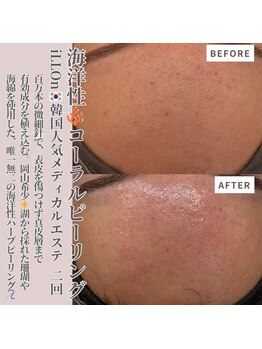 クラルテアンドコー(Salon Clarte&Co.)/ILLON◎コーラルピーリング/2回