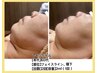 当日小顔実感★レモンボトルで不要な脂肪分解！鎮静リフトパック付き※原液
