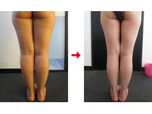 フォーレディ 恵比寿店/美脚★痩身エステ