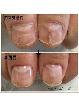 プライベートサロンエム(M)/自爪育成クリアジェル　¥6000