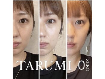 ミミルーチェ(mimiluce)/頑固ニキビケアお任せ下さい