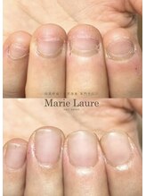 マリーロール 天王寺店(Marie Laure)/自爪育成/深爪矯正/ネイルケア
