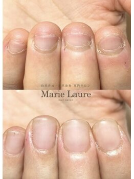 マリーロール 天王寺店(Marie Laure)/自爪育成/深爪矯正/ネイルケア