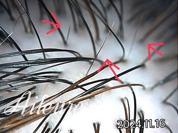 エルール トータルビューティ(Aileure total beauty)/育毛促進ケア