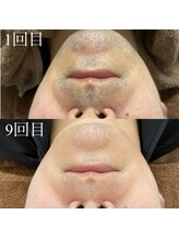 ランプ(LAMP)/～ハイブリッドヒゲ脱毛～