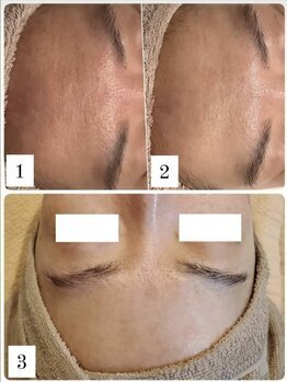 ラエッセ 目黒 白金台店(LAESSE)/毛穴・美白専門店 LAESSE 白金台