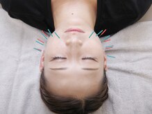 ネイビー鍼灸指圧治療院 那覇久米店(NAVY鍼灸指圧治療院)/指圧整体+美容鍼　60分コース