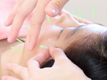 鍼灸院 はりのひと/痛みの少ない鍼施術