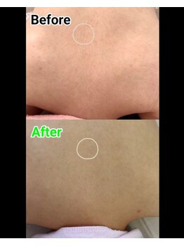 ビューティーサロン アンジェリークの写真/★１万人の施術実績★うなじ+もみあげ脱毛¥2980！自分では手の届かない箇所も自信を！
