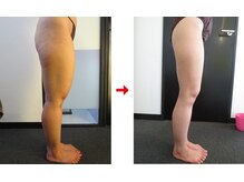 フォーレディ 恵比寿店/痩身★太もも-10.2cm↓↓↓