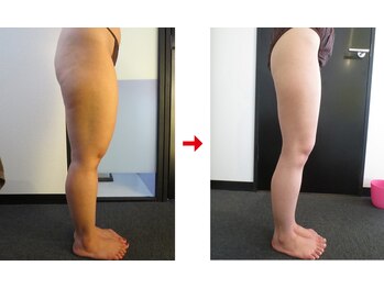 フォーレディ 恵比寿店/痩身★太もも-10.2cm↓↓↓