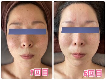 オルテンシア(Hortensia)/光フェイシャル&小顔コルギ