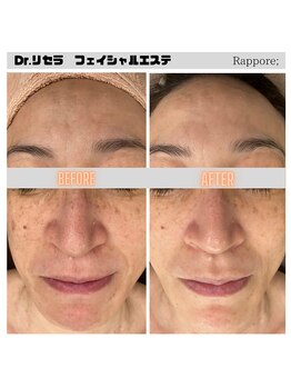 ラポール(rappore;)/高濃度水素コース