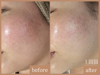 リムーン 岡崎(Re'moon)/REVI ハーブピーリング