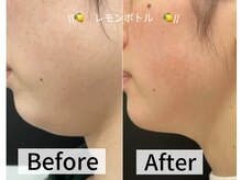 ルミナエステ(LUMINA ESTH)/脂肪分解剤レモンボトル 