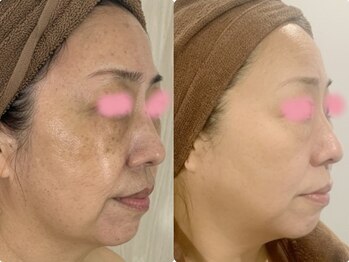 バービーフェイス 恵比寿(Barbie Face)/グリーンピール５Days 2回