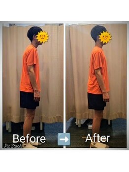 クシロ鍼灸整骨院/中学生の姿勢矯正　施術例