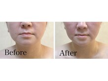 リブ 三軒茶屋(LiB)/本格小顔ケア