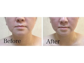 リブ 三軒茶屋(LiB)/本格小顔ケア