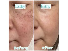 エスティ 津田沼店の雰囲気（シミ・くすみ【最新光フェイシャル】日本初OPL※クーポン配信中）