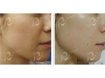 ハーバリー ハーブピーリング 岐阜(HERBERRYハーブピーリング)/ハーブピーリング専門店HERBERRY