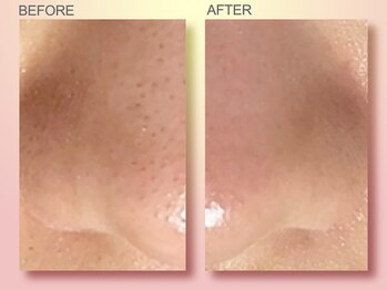 ジュリア オージェ 四条河原町店/ビフォーアフター（鼻スパ）