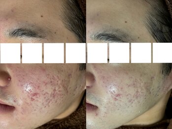 リボーン(REBORN)/ハーブピーリング