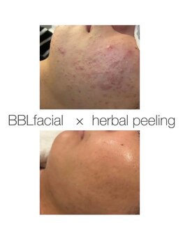 グラント(grant)/BBL×ハーブ ビフォーアフター