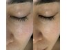 ≪美白・たるみ改善≫エレクトロポレーション＋マイクロニードルピーリング