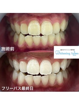 ホワイトニングサロン 熊本店/ホワイトニングで綺麗な歯