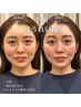 回数券【エラの張り/ほうれい線】顔専門整体　小顔矯正5回　8000→6400