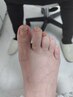 【巻き爪】インベントプラス初回