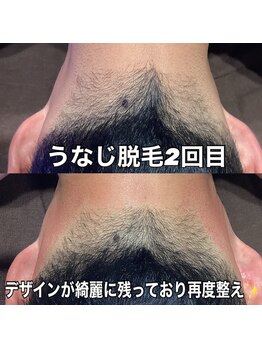 リエル(RIEL)/【うなじ脱毛】