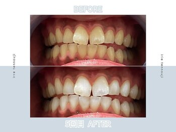 アイリー ホワイトニング 難波店/セルフホワイトニング☆クーポン