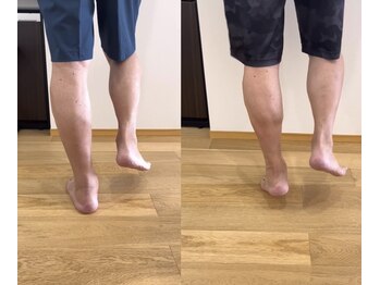 ランドル(rendre)/アキレス腱の痛み