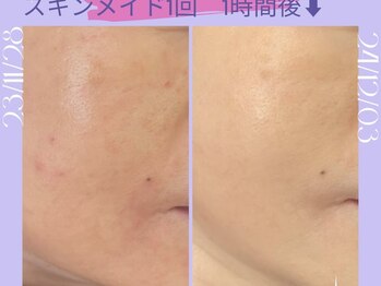 リラクゼーションサロン ラキ(laki)/スキンメイド【赤み・美白】