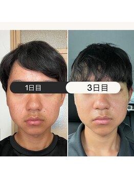 リラクゼーションサロン ラキ(laki)/ハイピールイントゥ/ピーリング