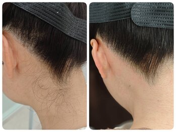 アルマサロン 菊陽(Almasalon)/ムダ毛スッキリ!　うなじ美人