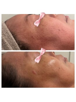 美温(mion)/マーメイドセルトリートメント