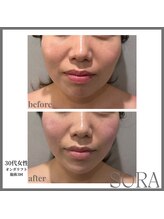 青空 天神大名店(SORA)/オンダリフト60Kj1回