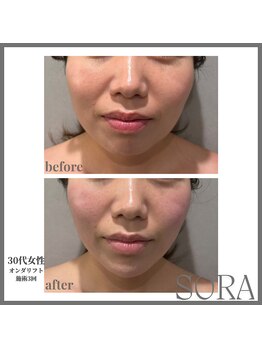 青空 天神大名店(SORA)/オンダリフト60Kj1回