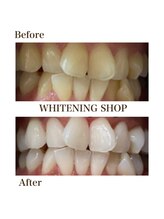 ホワイトニングショップ 徳島藍住店/Before After美白ホワイトニング