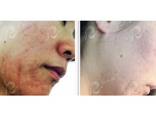 ハーバリー ハーブピーリング 岐阜(HERBERRYハーブピーリング)/ハーブピーリング専門店HERBERRY