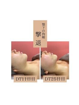 インディバケアプラチナム 横浜店/インディバ施術