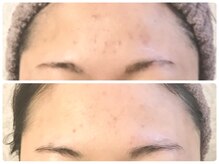 ラウン 京都(ROUN')/3回の施術ビフォーアフター