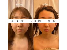 ビーキュート 渋谷北参道店(BE-CUTE)/Before・After 施術20回
