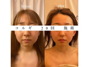 ビーキュート 渋谷北参道店(BE-CUTE)/Before・After 施術20回