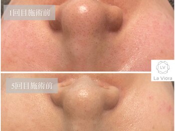 ラヴィオーラ 明石店(La Viora)/ダイヤモンドハーブピーリング